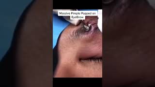 Blackheads Popping amp Blackhead Removal Videos 2022 [upl. by Cormac]