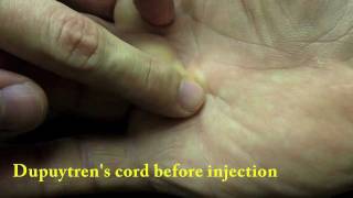 Xiaflex collagenase injection for Dupuytrens Finger Contracture [upl. by Brier]