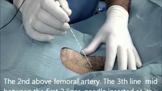 Obturaor nerve block modified inguinal technique nerve stimulaionwmv [upl. by Ydnarb]