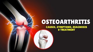 Osteoarthritis – Causes Signs and Symptoms Diagnosis amp Treatment [upl. by Nomolos]