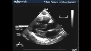 TheEchoWeb  Tetralogy of Fallot [upl. by Kappel]