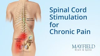 Spinal Cord Stimulation for Chronic Pain [upl. by Munford319]