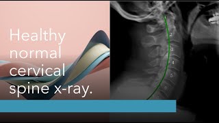 Platinum Chiropractic Erina Xray Explanation [upl. by Odelle]