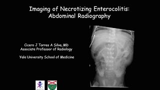 Necrotizing enterocolitis [upl. by Yrocej]