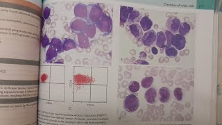 Acute Myeloid Leukemia  SPECIAL PATHOLOGY [upl. by Seigel799]