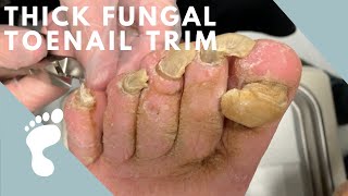 A Thick and Fungal Toenail [upl. by Nnail41]