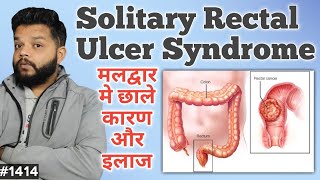 मलद्वार मे छाले का कारणलक्षण और इलाज  Solitary Rectal Ulcer Syndrome Explain In Hindi [upl. by Assina]