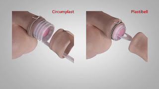 A comparison of Circumplast® and Plastibell® Circumcision Devices [upl. by Eidassac]