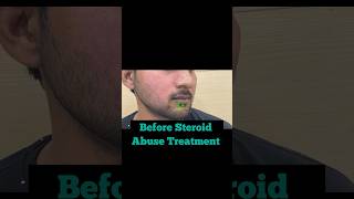 Steroid abuse Treatment  say no to steroids  Dermatologist in Punjab  Dr Ashima Goel skincare [upl. by Enyaw267]