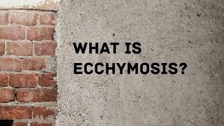 What is ecchymosis [upl. by Orling]