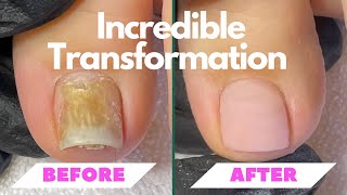 Incredible Toenail Transformation with NanoFlex by Fuzion [upl. by Ahsinwad]