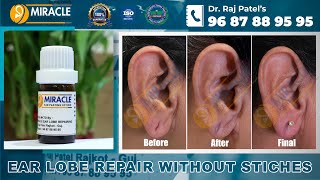 Ear Lobe Repair  Ear Holl Repair  Torn Ear Repair  Ear Pasting Lotion Available Call  9687889595 [upl. by Emarie]