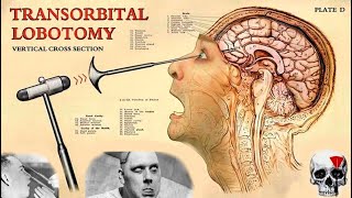 The TERRIFIC History of Lobotomy [upl. by Damek279]