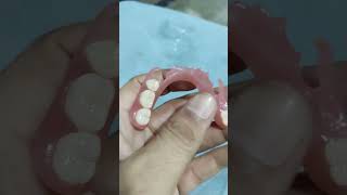 Flexible Partial Denture 😁😁😁flexible dentures dentalartbyhaider [upl. by Anicart218]