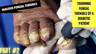 Massive Fungal Toenails  Trimming Fungal Toenails of a Diabetic Patient  Part 2 Podiatry [upl. by Namya285]