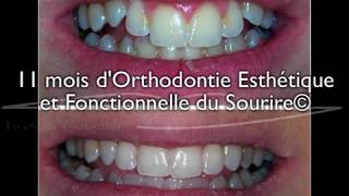 Sourire gingival sur adolescent  correction en 11 mois par aligneurs® en OEFS© [upl. by Matheson]