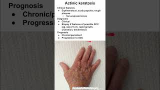 Removal of pigmented seborrheic keratosis [upl. by Doherty]