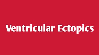 Ventricular Ectopics [upl. by Tore]