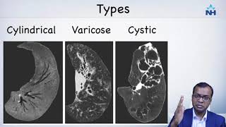 CT imaging and diagnosis of Bronchiectasis [upl. by Mcquillin]