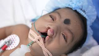 Rare Cleft Baby Going under Sleep Anesthesia [upl. by Eitac825]