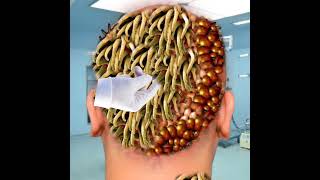 Asmr maggot infected head back side  remove treatment infection  removal 2d ani SakirTech1 [upl. by Leland]