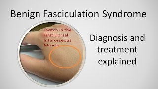 Nondisjunction Trisomy 21  An Animated Tutorial [upl. by Torry]