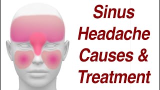 Sinus Headaches Causes amp Treatment [upl. by Irelav]