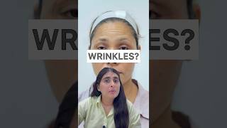 Wrinkles  How to get rid of forehead wrinkles Botox Botox treatment for face skincare wrinkles [upl. by Ddahc832]