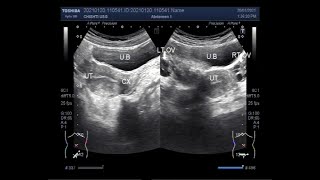 Polycystic ovary syndrome PCOS with Diagnostic criteria [upl. by Ahsined437]