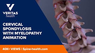 Cervical Spondylosis with Myelopathy Animation [upl. by Dygert209]