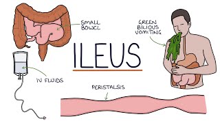 Understanding Ileus Paralytic Ileus [upl. by Enrak]