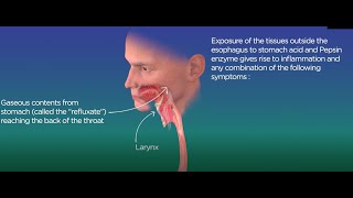 What is silent reflux and what can be done to relieve symptoms [upl. by Ardnos]