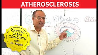 Atherosclerosis  Pathophysiology [upl. by Nauqes412]