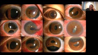 Trauma Ocular Penetrante Córnea Iris y Cristalino [upl. by Kcirderfla]