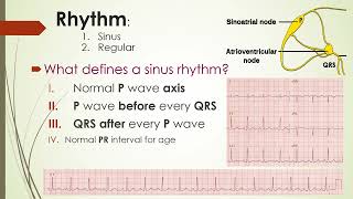 ECG Reading 2 د عمر الجنيد [upl. by Mariele387]