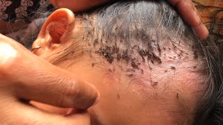 Removing Thousands Of Lice From Long Hair How To Remove It [upl. by Algernon969]