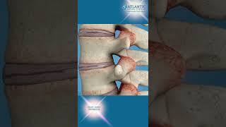 What is Facet Joint Syndrome [upl. by Ado]