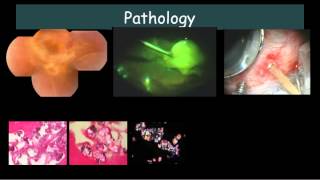 Bilateral Exudative retinal detachment with subretinal exudates Dr E M Dodds [upl. by Bouchard]