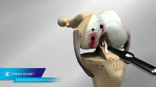 Oxford® Partial Knee Microplasty® Instrumentation Animation [upl. by Kristien386]