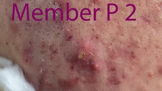 Acne Treatment Huong Da Nang 038  Loyal fans Mai Part 2 [upl. by Terence]