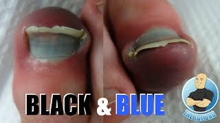 How to Prevent amp Treat Black Toenail  Foot Care [upl. by Spurgeon]