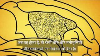 What is Alzheimers Disease Hindi [upl. by Garrick]