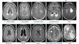 MRI Uses in MS [upl. by Bouton328]