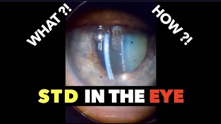 STD in the Eye  Syphilis  Uveitis [upl. by Aioj9]