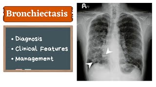 Bronchiectasis  Clinical features amp Management [upl. by Eeclehc694]