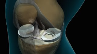 Anterior Cruciate Ligament ACL Reconstruction Animation [upl. by Kassie]