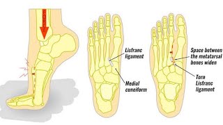 Lisfranc injury what’s new in lisfranc screw vs plates classificationdiagnostic technique [upl. by Garbers]