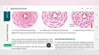 Hypertensive arteriosclerosis in Hindi  pathology videos [upl. by Janelle438]