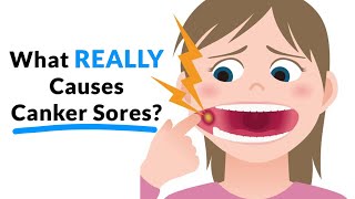 What REALLY Causes Canker Sores [upl. by Armalla]