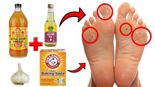 14 Proven Home Remedies For Corns amp Callus Removal THAT WORK [upl. by Alenoel626]